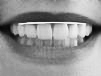Perfect Smile gum line